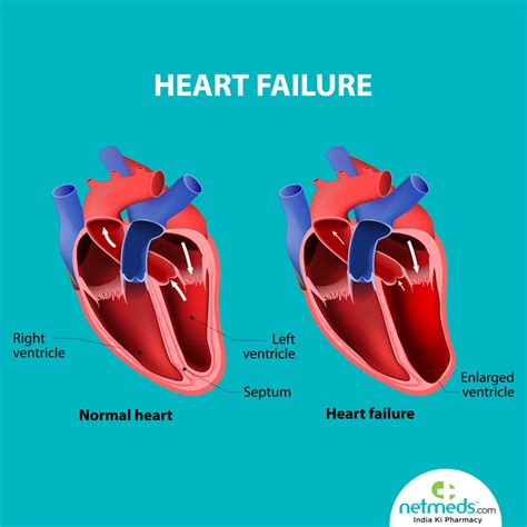 what is moderate Lv impairment